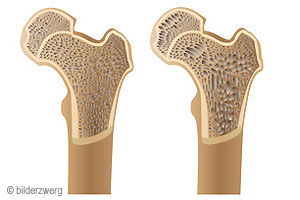 Osteoporose 